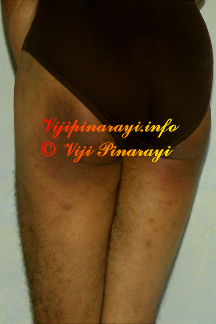 Cane marks caused by Anju Chechi's caning on my buttocks and thighs‍
